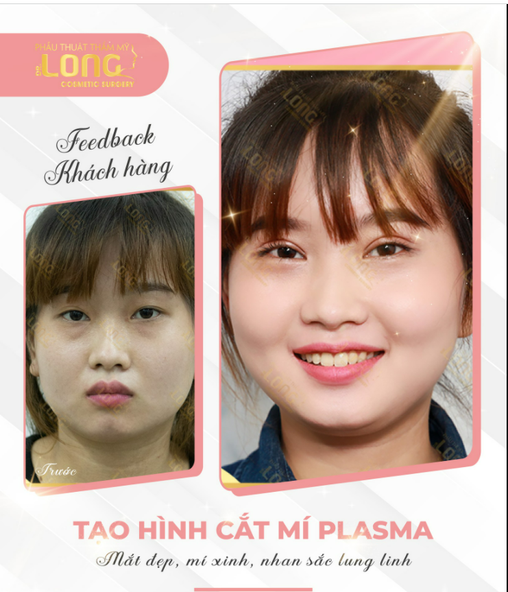 SAU CHIA TAY…..CHIA TAY QUÁ KHỨ MẮT 1 MÍ CHỈ SAU 30 PHÚT CẮT MÍ TẠI BS LONG