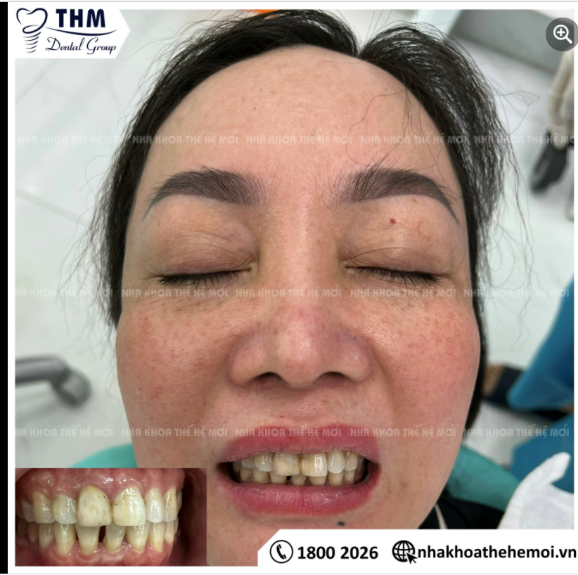 Sau khi thăm khám và được tư vấn bác sĩ chuyên môn, Ms. Thị Vũ đã lựa chọn bọc răng toàn sứ Zirconia tại Nha Khoa Thế Hệ Mới.