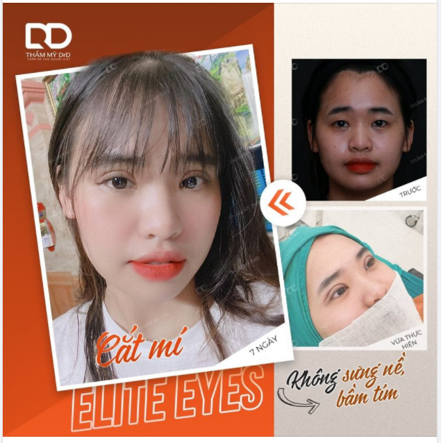 SEE MÊ chiếc mí chỉ mới được 1 tuần tuổi. Không sưng nề, bầm tím bởi kỹ thuật rút ngắn thời gian xâm lấn.