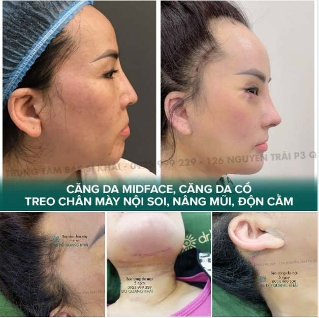SẸO CĂNG DA MẶT BAO GIỜ LÀNH