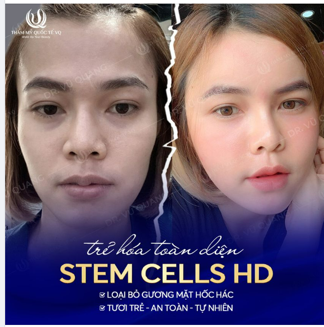 Siêu trẻ hóa Stem Cells HD - Đẩy lùi tuổi già, trẻ ra 10 tuổi chỉ sau 45 phút