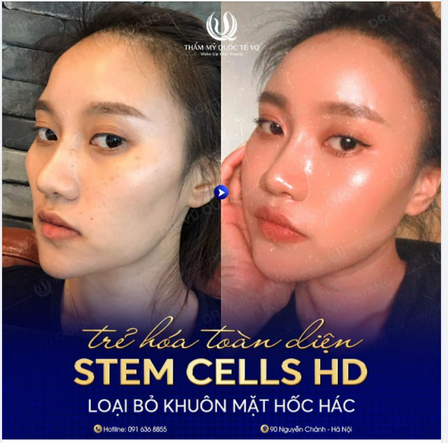 Siêu trẻ hóa Stem Cells HD - Xinh bất ngờ - Trẻ ngỡ ngàng