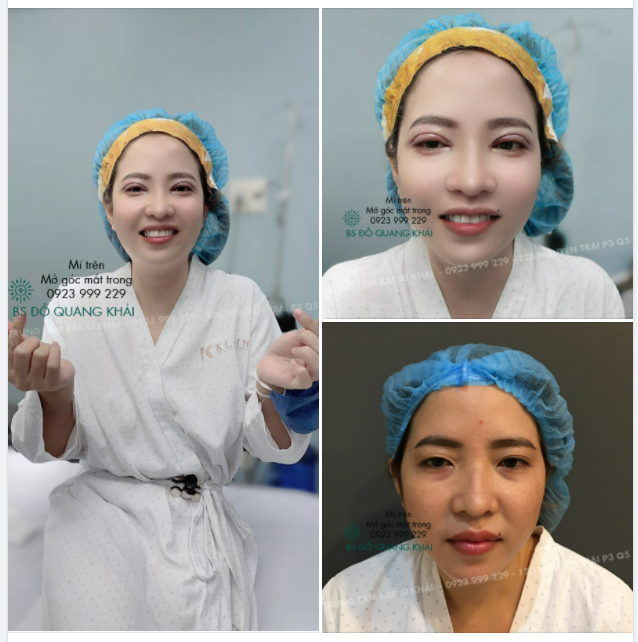SỞ HỮU ĐÔI MẮT 2 MÍ ĐẸP TINH TẾ với KĨ THUẬT CẮT MÍ TẠI TRUNG TÂM BS KHẢI