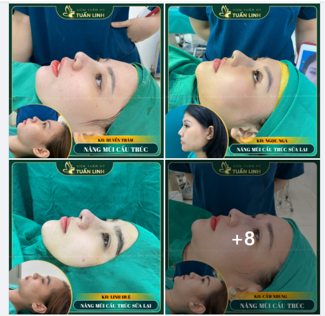 SỞ HỮU NGAY DÁNG MŨI XINH CHỈ SAU 90 PHÚT PHẪU THUẬT.
