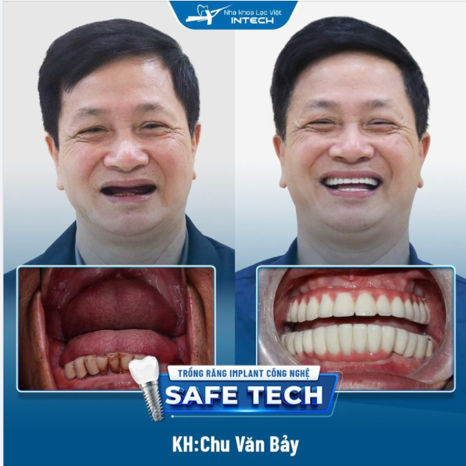 SỐNG VUI KHOẺ NHỜ TRỒNG RĂNG IMPLANT CÔNG NGHỆ SAFE-TECH