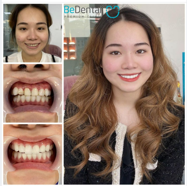 Sự khác biệt khi làm răng sứ chính hãng tại Bedental