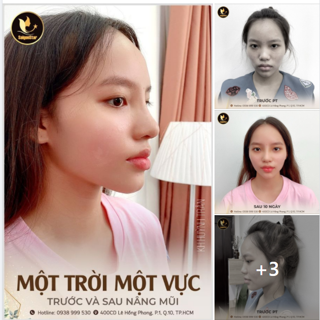 SỰ KHÁC BIỆT MỘT TRỜI MỘT VỰC TRƯỚC VÀ SAU NÂNG MŨI CỦA HUỲNH TRÂN