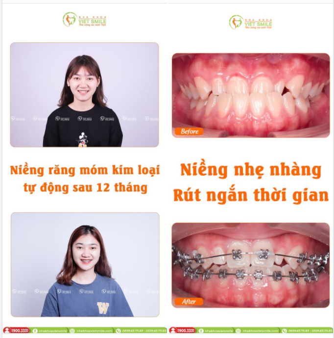 SỰ THAY ĐỔI SAU 12 THÁNG NIỀNG RĂNG MÓM, KHỚP CẮN NGƯỢC