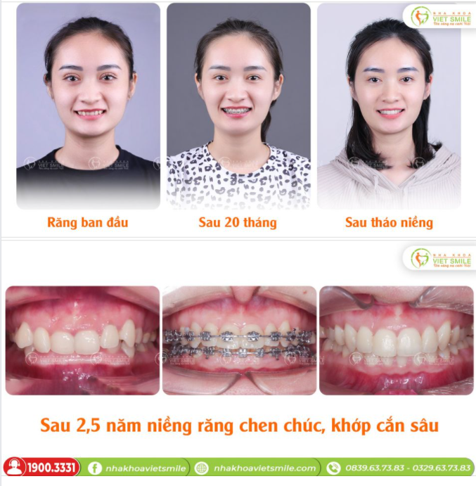 SỰ THAY ĐỔI TRONG HÀNH TRÌNH NIỀNG RĂNG KHỚP CẮN SÂU