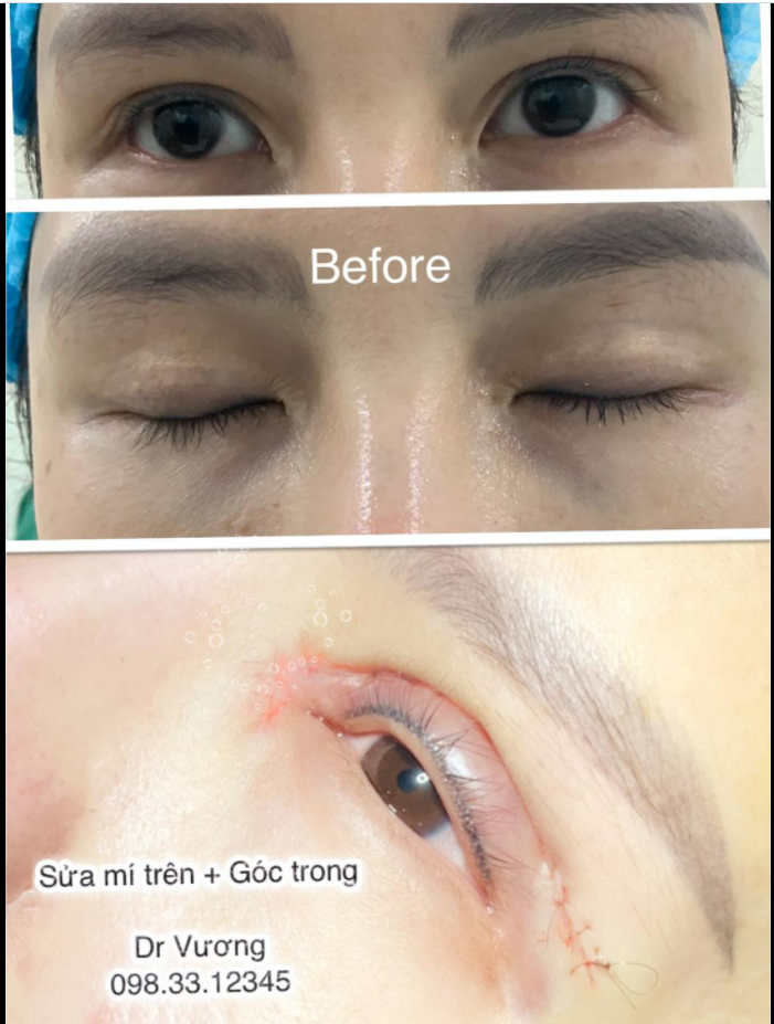 Sửa mí trên + Góc mắt trong với Dr Vương