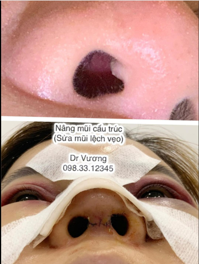 Sửa mũi lệch vẹo = nâng mũi cấu trúc với Dr Vương !