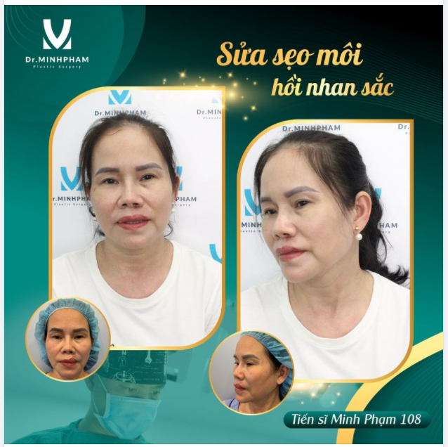 SỬA SẸO MÔI - HỒI NHAN SẮC CHO CHỊ KHÁCH U50