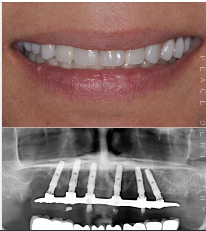 TÁI KHÁM IMPLANT SAU 4 NĂM
