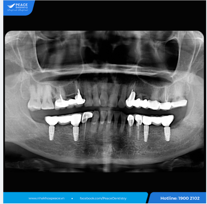 TÁI KHÁM IMPLANT SAU 5 NĂM