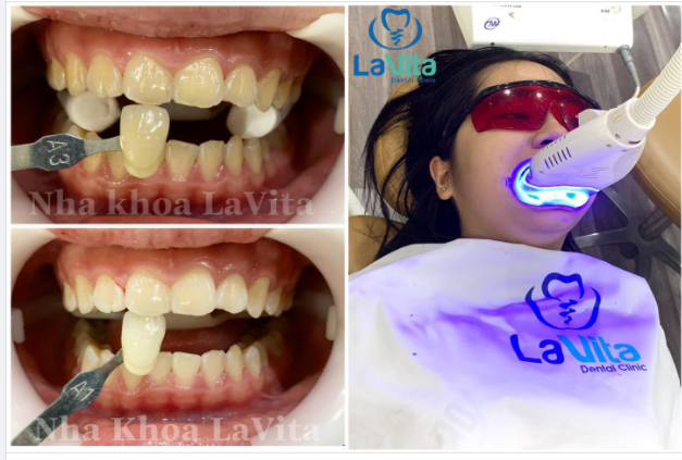 TẠI SAO BẠN NÊN LỰA CHỌN TẨY TRẮNG RĂNG TẠI NHA KHOA LAVITA