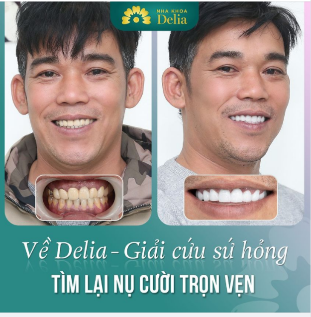 TÁI SINH RĂNG SỨ HỎNG - LẤY LẠI NỤ CƯỜI TỰ TIN