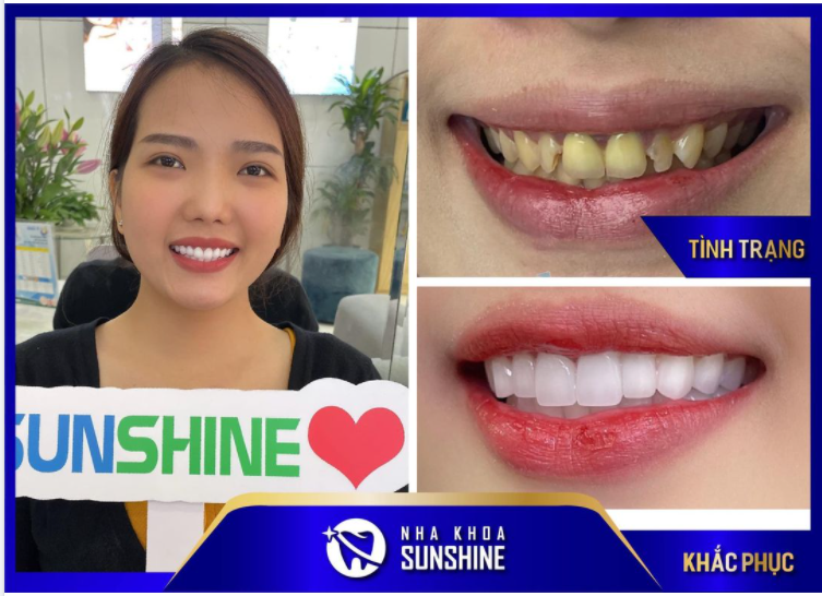 TẠM BIỆT HÀM RĂNG SỨT MẺ, Ố VÀNG 