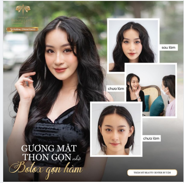“TẠM BIỆT” Khuôn mặt bánh bao - Diện mạo mới xinh đẹp của bạn khách hàng tiêm botox gọn hàm bên Tấm.