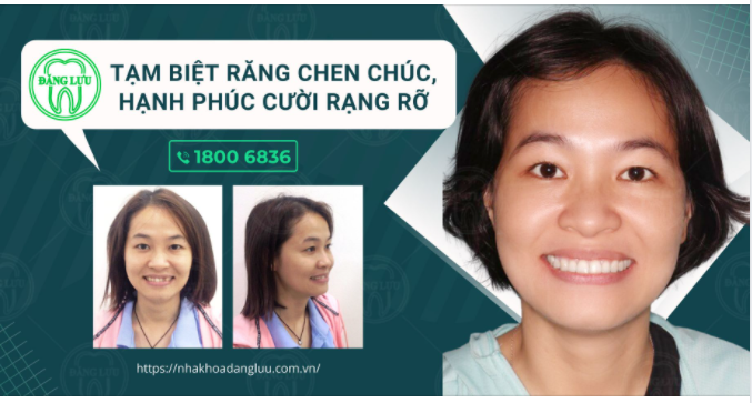 Tạm biệt răng chen chúc, hạnh phúc cười rạng rỡ