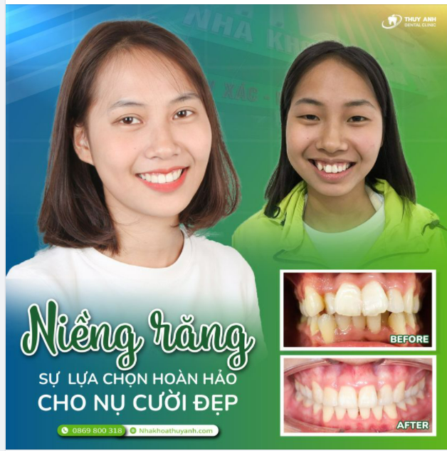 TẠM BIỆT RĂNG HÔ VÀ NHỮNG BIỆT DANH XẤU XÍ