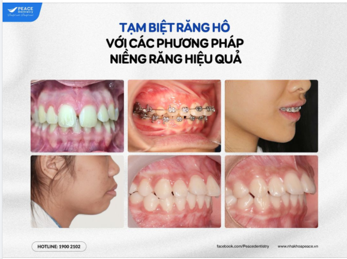 TẠM BIỆT RĂNG HÔ VỚI CÁC PHƯƠNG PHÁP NIỀNG RĂNG HIỆU QUẢ