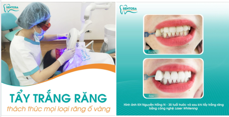 TẠM BIỆT RĂNG Ố VÀNG VỚI CÔNG NGHỆ TẨY TRẮNG RĂNG LASER WHITENING