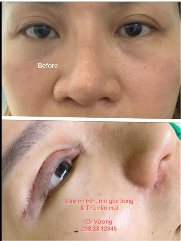 Tận lực phục vụ các bạn SG, giờ mới có tgian đăng ảnh 1 ca sửa mí trên, mở góc trong thu nền mũi cho bạn gái Quận 1.