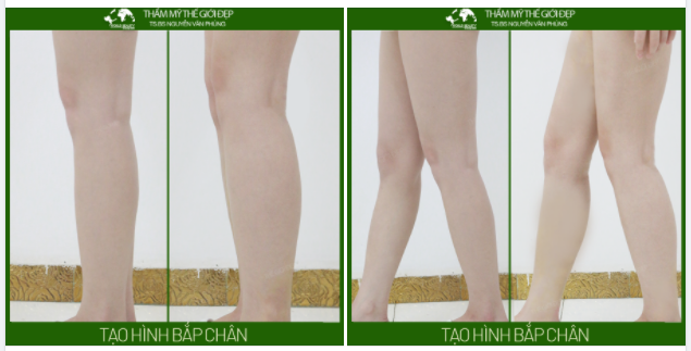 Tạo hình bắp chân bằng túi đ.ộn kết hợp cấy m.ỡ tự thân - Giải pháp giúp loại bỏ triệt để các khuyết điểm đôi chân teo nhỏ, yếu mảnh...