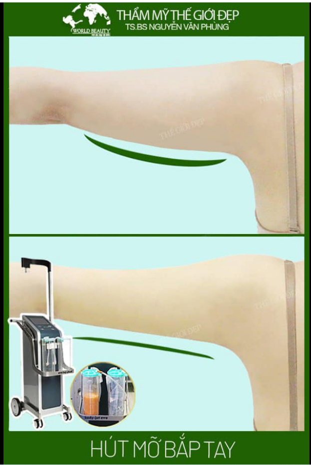 Tạo hình bắp tay thon gọn, săn chắc bằng công nghệ hút mỡ Body- jet- Evo chuẩn Châu Âu