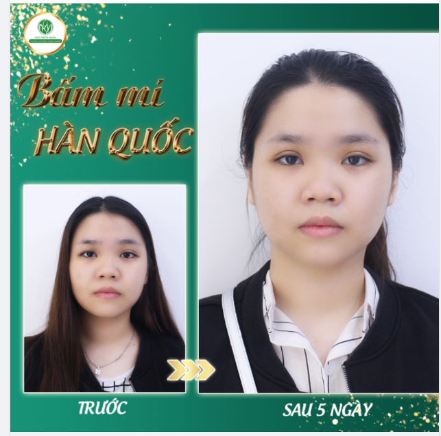 TẠO MẮT 2 MÍ KHÔNG PHẪU THUẬT VỚI PHƯƠNG PHÁP BẤM MÍ HÀN QUỐC