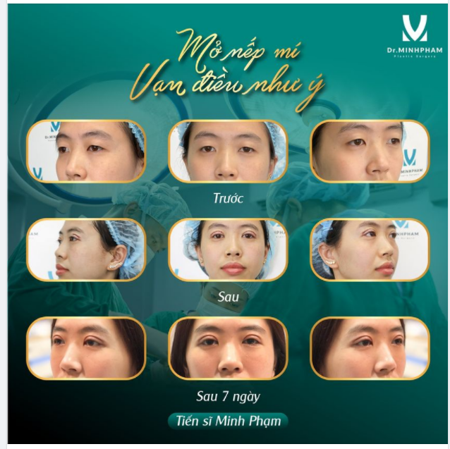 TẠO NẾP MÍ - VẠN ĐIỀU NHƯ Ý