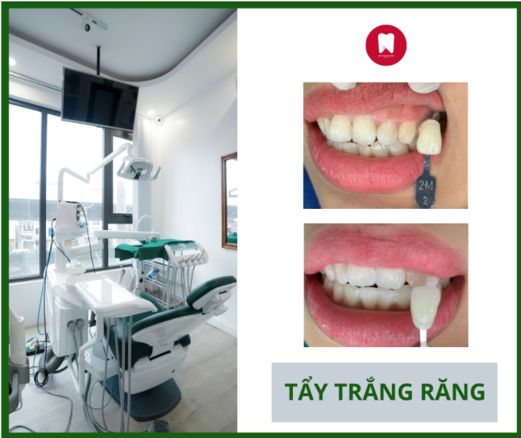 TẨY TRẮNG RĂNG CHỈ SAU 45 PHÚT