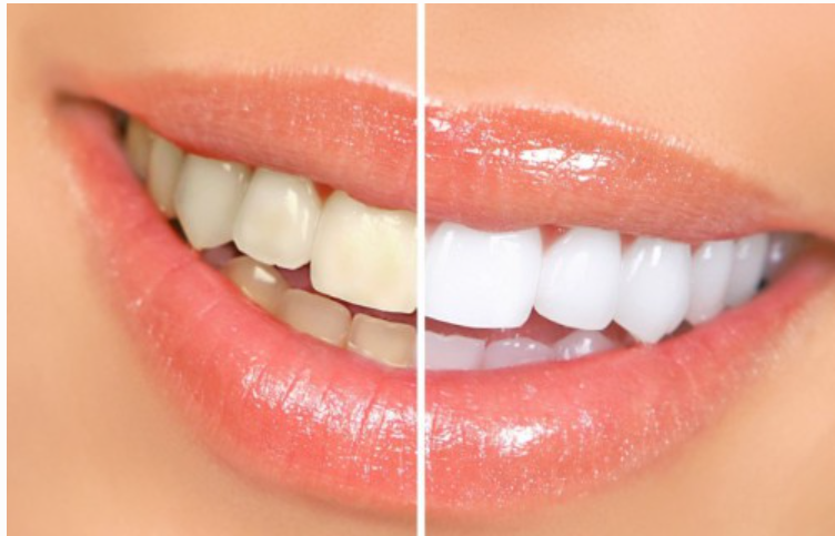 Tẩy trắng răng giữ được trong bao lâu?