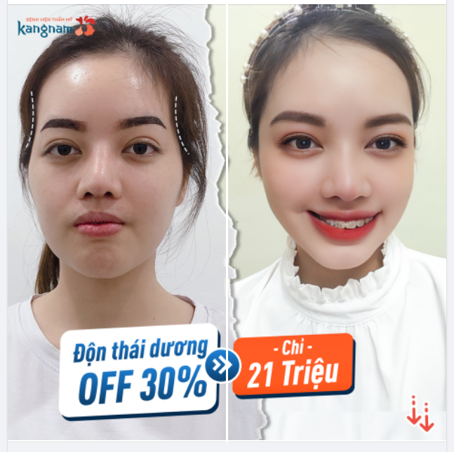 Thái dương lõm hóp làm khuôn mặt mất cân đối