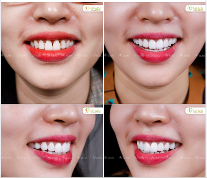 THẨM MỸ 16 RĂNG SỨ DÁNG THANH MẢNH CHO NỤ CƯỜI TỰ TIN