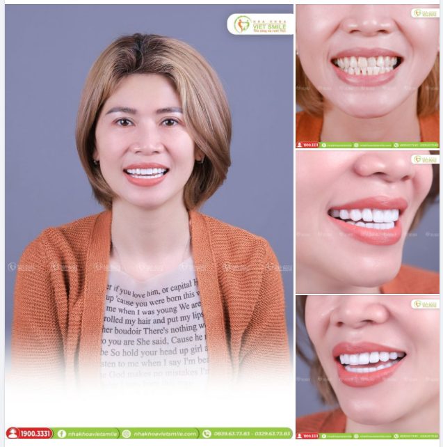 THẨM MỸ 20 RĂNG SỨ HT SMILE THỦ CÔNG
