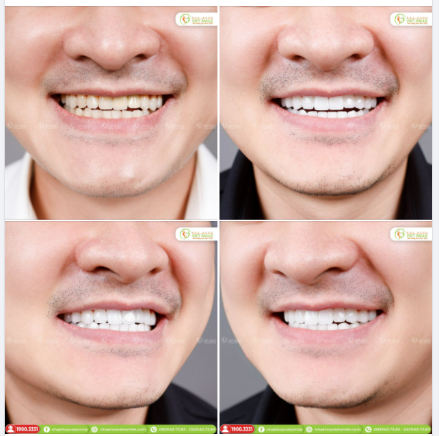 THẨM MỸ 21 RĂNG SỨ NACERA THỦ CÔNG