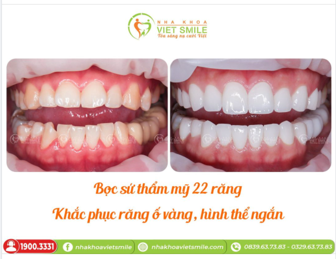 THẨM MỸ 22R SỨ - KHẮC PHỤC RĂNG Ố VÀNG, HÌNH THỂ NGẮN