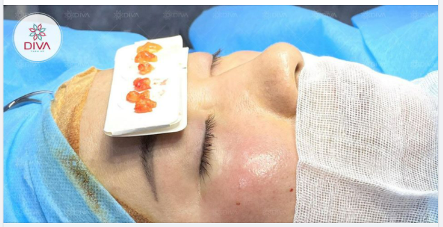 THẨM MỸ LẤY TÚI MỠ MẮT DƯỚI - TRẺ HÓA ĐÔI MẮT