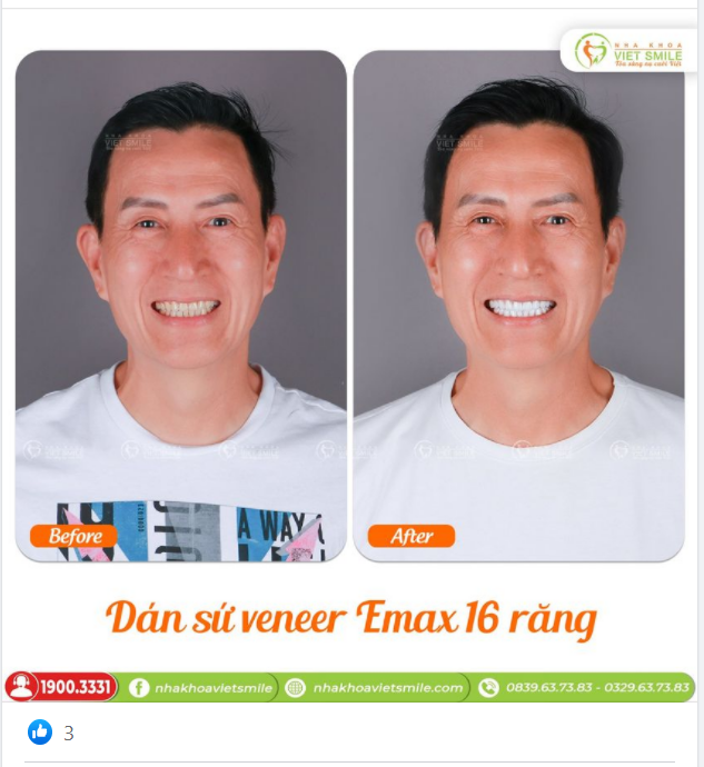 THẨM MỸ NỤ CƯỜI PHÁI MẠNH - DÁN SỨ VENEER EMAX 16 RĂNG