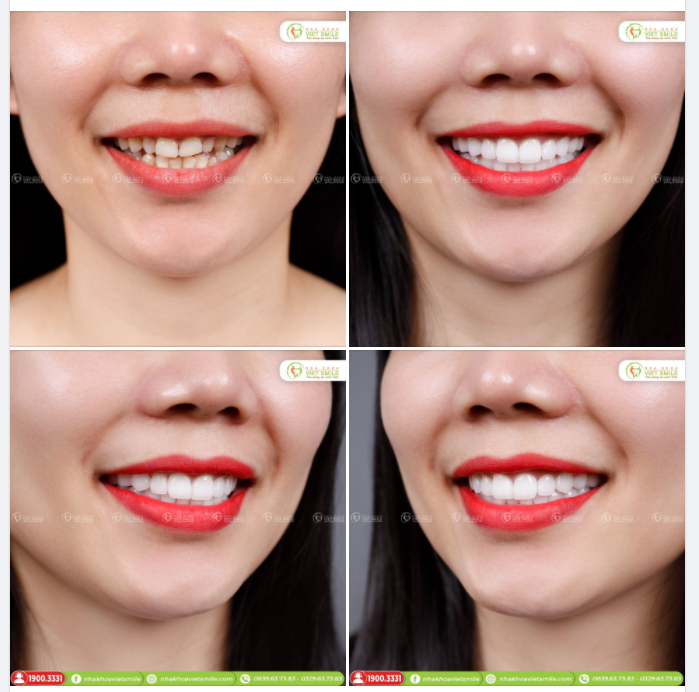 THẨM MỸ NỤ CƯỜI TỰ TIN CÙNG SỨ NACERA