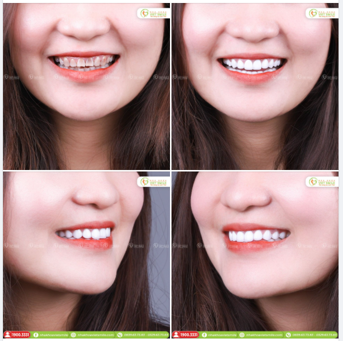 THẨM MỸ NỤ CƯỜI VỚI 20 RĂNG SỨ LAVA PLUS 