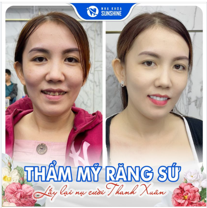 THẨM MỸ RĂNG SỨ - BÍ QUYẾT CHO NỤ CƯỜI KHÔNG TUỔI