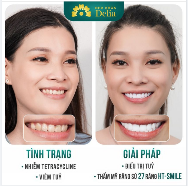 Thẩm mỹ răng sứ rạng rỡ nở nụ cười tự tin