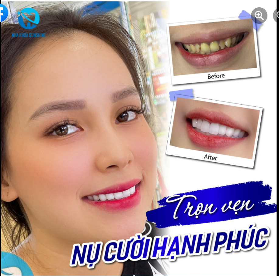 Thẩm mỹ răng sứ - Trọn vẹn nụ cười Hạnh phúc