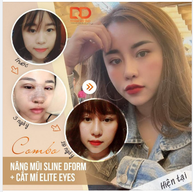 Tháng 4 có thể là lời nói dối của ai đó. Còn ưu đãi Nâng mũi Sline + Cắt mí Elite Eyes là thật.