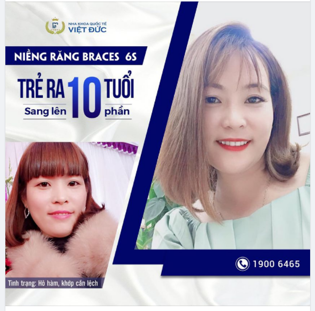 THĂNG HẠNG NHAN SẮC NHỜ NIỀNG RĂNG BRACES 6S