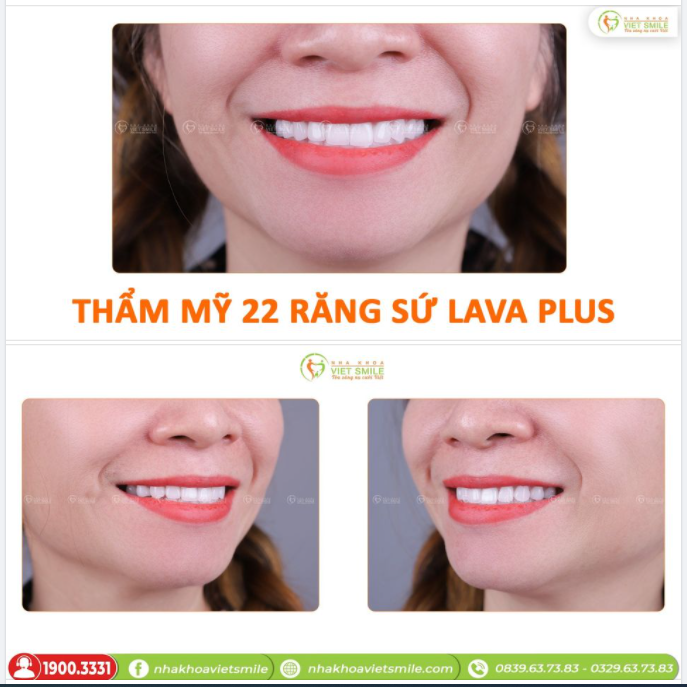 THĂNG HẠNG NỤ CƯỜI CÙNG 22 RĂNG SỨ LAVA PLUS