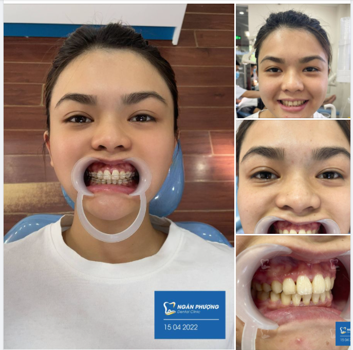 Tháo niềng có liền răng xinh 