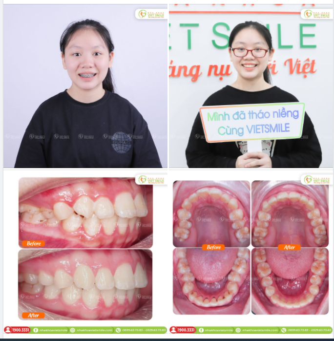 THÁO NIỀNG RĂNG HÔ, CHEN CHÚC SAU 19 THÁNG